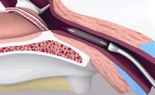 Läpileikkaus korvatorven pallolaajennuksesta